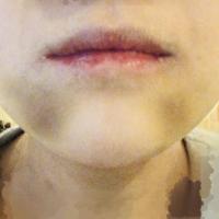 顎関節症 顎変形症 人気ブログランキング